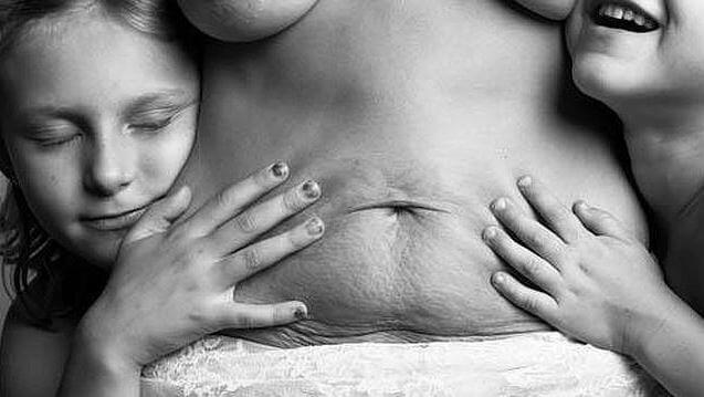 Existem cicatrizes que nos lembram da coisa mais bela da vida: os filhos