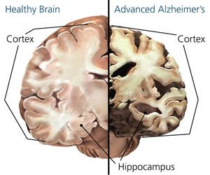 cerebro-mal-de-alzheimer