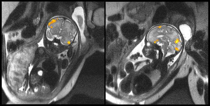 atividade-cerebral-feto