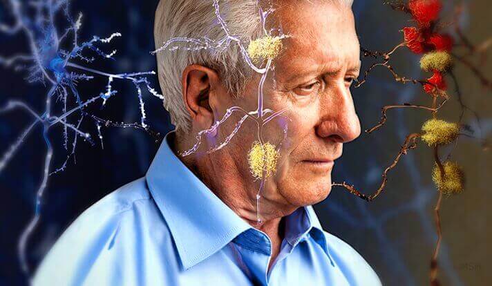 Sinais que precedem o Alzheimer