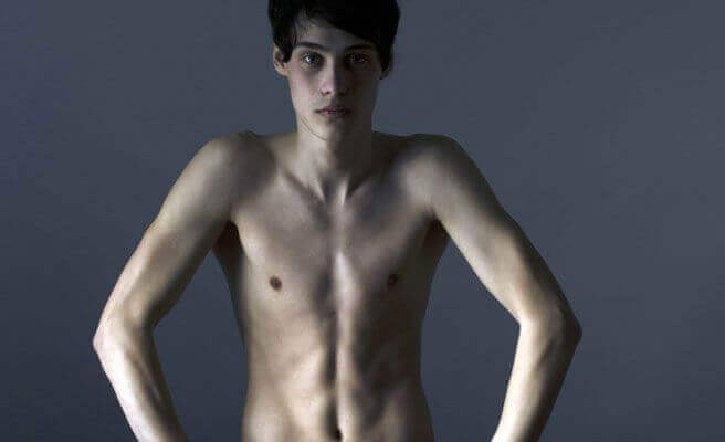 Adolescente com anorexia