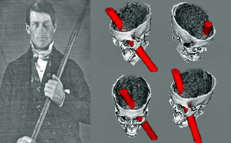 O caso de Phineas Gage