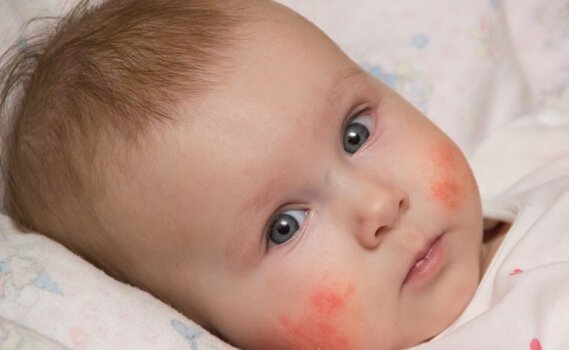 Criança com dermatite atópica