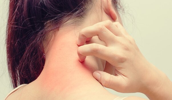 Dermatite atópica e a sua relação com o estresse