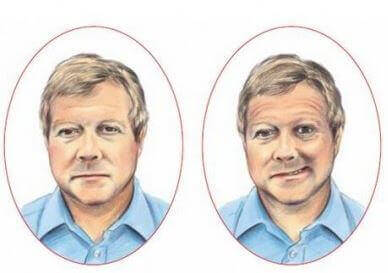 Consequências do AVC