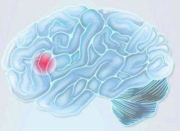 Acidente vascular cerebral