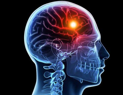 Quais são as causas e tipos de acidentes vasculares cerebrais?