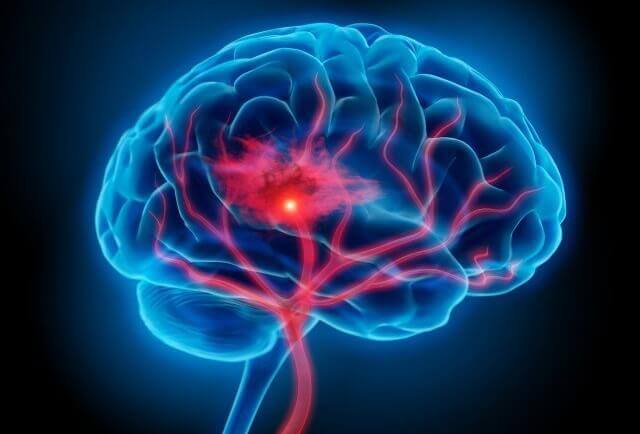 Neuroinflamação