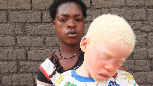 Criança com albinismo