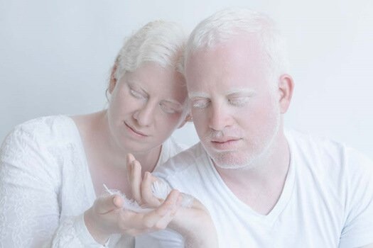 Mulher e homem albinos