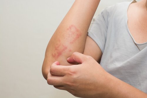 6 conselhos para tratar a dermatite atópica