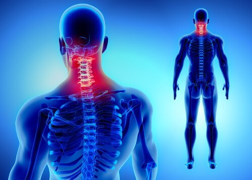 Torcicolo cervical