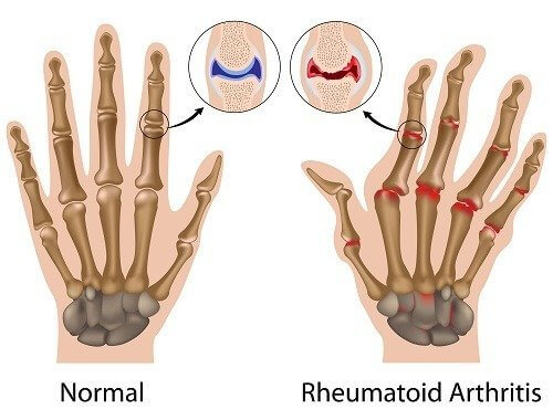 Artrite reumatoide