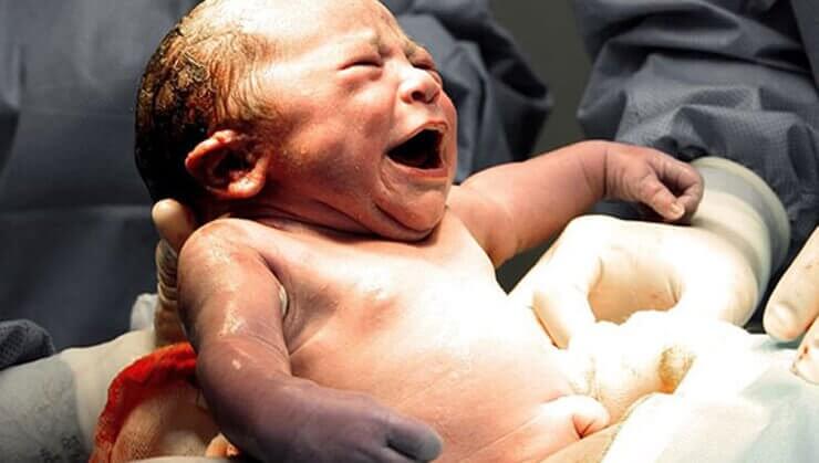 Bebê chorando ao nascer