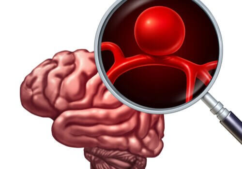 Aneurisma cerebral