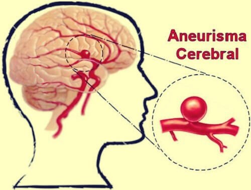 Aneurisma Cerebral Definição Sintomas E Tratamentos 1673