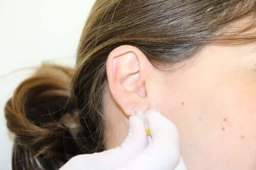 Acupuntura