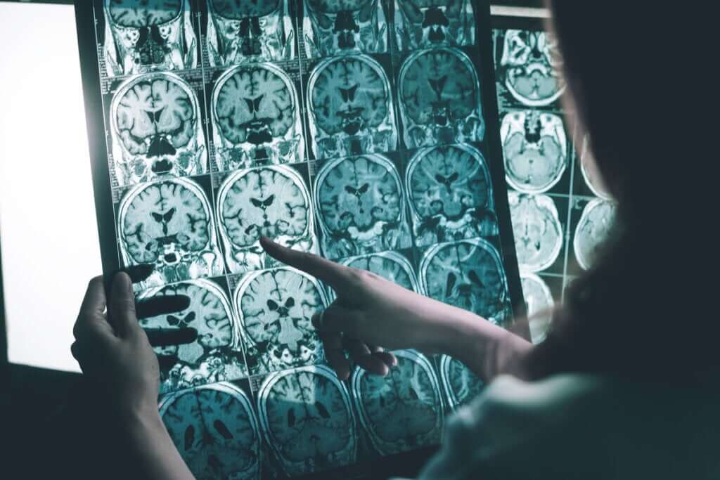 Ondas gama contra a doença de Alzheimer