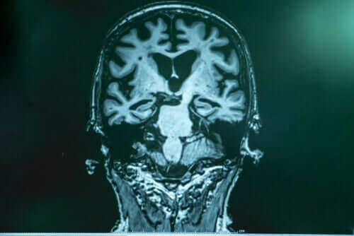 Cérebro com Alzheimer