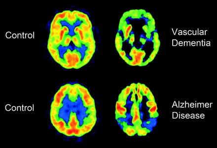 Tomografias cerebrais