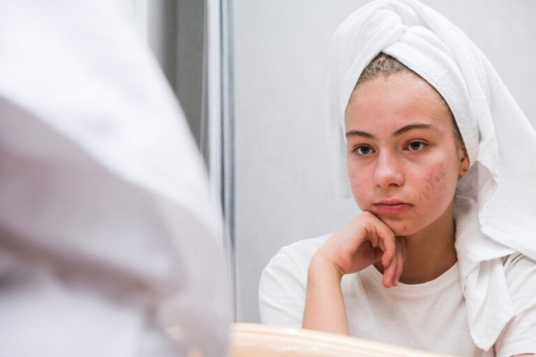 O impacto psicológico da acne na adolescência