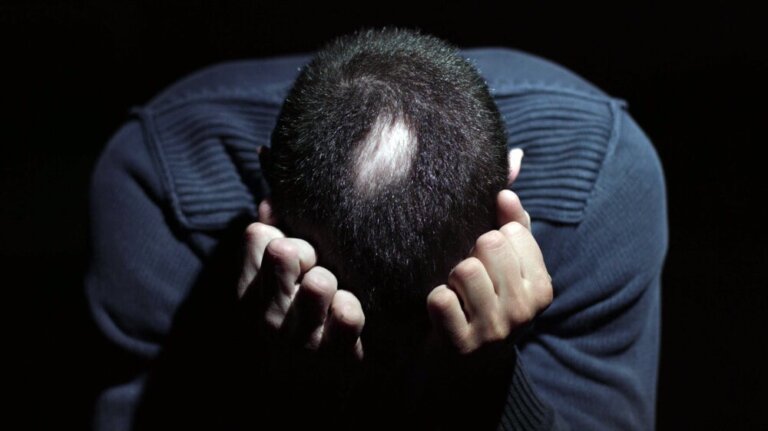 Alopecia areata e estresse: como estão relacionados